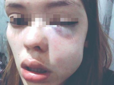 Desfiguró a golpes a su ex y dijo que solo se defendió