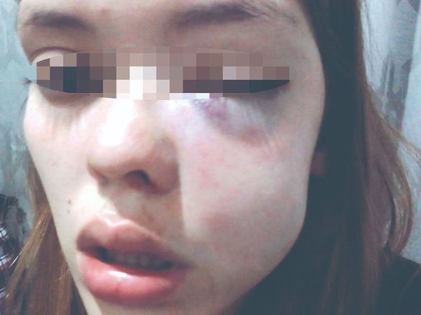 Desfiguró a golpes a su ex y dijo que solo se defendió