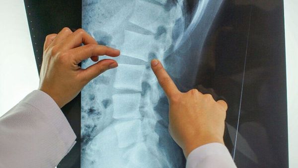 Médico argentino explica qué es la Mielitis transversa, el efecto secundario que frenó la vacuna de Oxford - Megacadena — Últimas Noticias de Paraguay