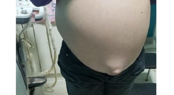 Extirpan un tumor gigante de 16 kilos a una mujer - Noticiero Paraguay