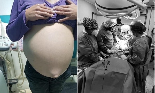 Destacan exitosa extracción de masa tumoral gigante de 16 kilos de una mujer - ADN Paraguayo