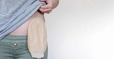La Nación / Día del Ostomizado: “Se pasa mal en Paraguay porque no está preparado”, afirma expaciente