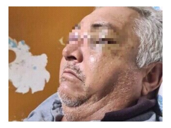 Golpeó con hierro a su papá y le hundió la cara