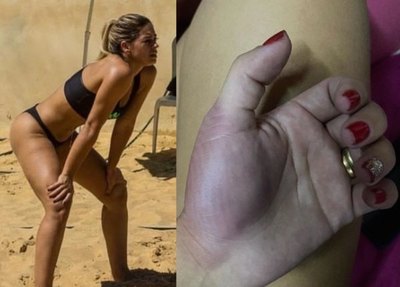 Crónica / Jugando piki se reventó la mano para no romperse las uñas