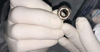La Nación / A extremar cuidado: niña tragó una tuerca y casi se asfixia