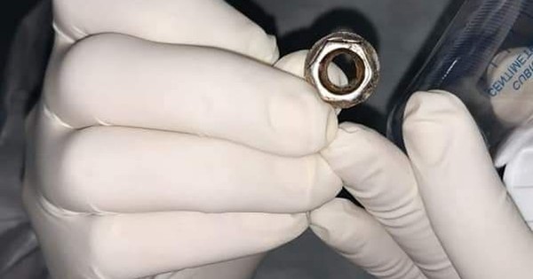 La Nación / A extremar cuidado: niña tragó una tuerca y casi se asfixia