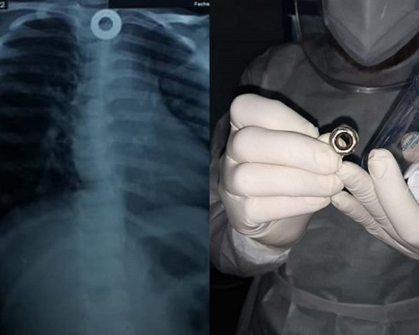 Médicos del Ineram extraen una tuerca del esófago a una niña de 5 años