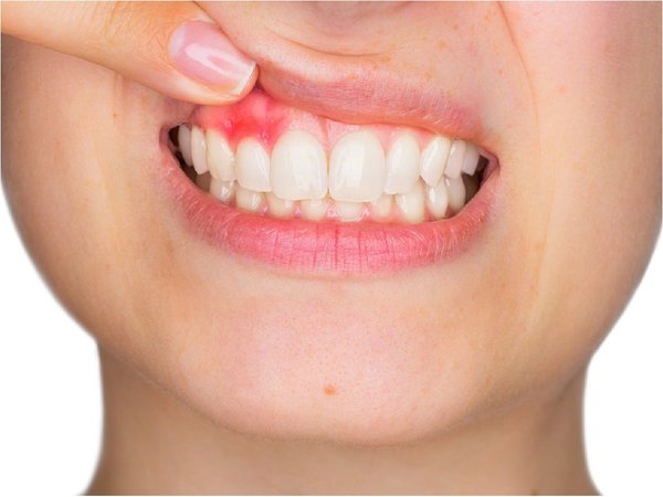 Desentrañan cómo la periodontitis puede causar demencia
