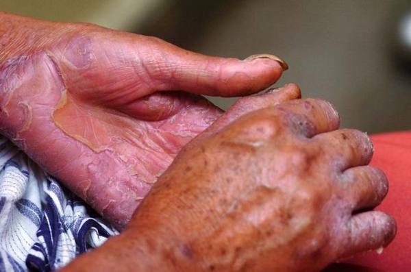 Hay que hablar sobre la lepra para romper los prejuicios y estigmas, sostienen » Ñanduti