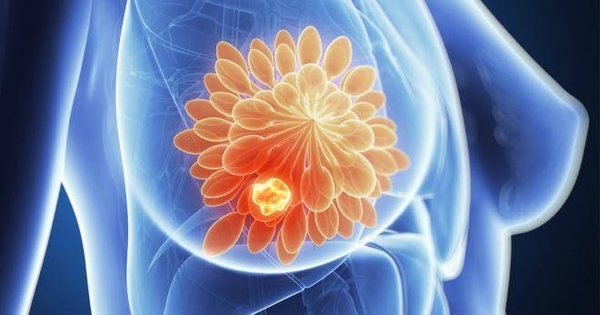 HOY / Mitos y verdades sobre el cáncer: ¿Aumenta el riesgo con el uso de desodorante y con implante mamario?