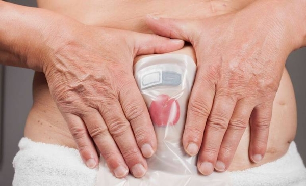 HOY / Pacientes ostomizados exigen que Aduanas libere insumo retenido hace 3 meses