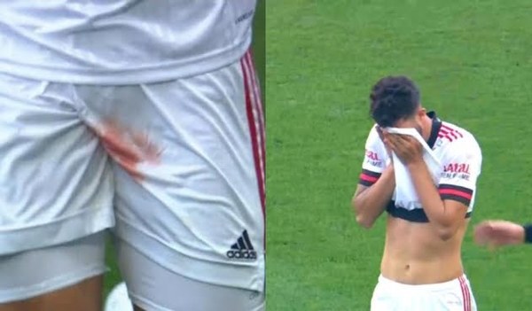 Futbolista pierde testículo tras recibir una patada - Noticiero Paraguay