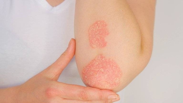 HOY / La Psoriasis: con causa desconocida es una enfermedad crónica que requiere un seguimiento controlado