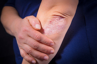 Psoriasis, una enfermedad poco difundida y muy frecuente