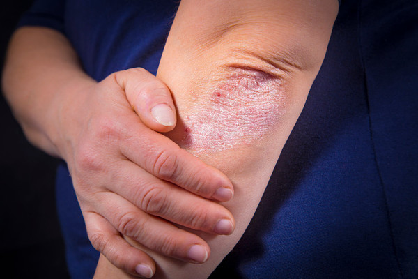 Psoriasis, una enfermedad poco difundida y muy frecuente