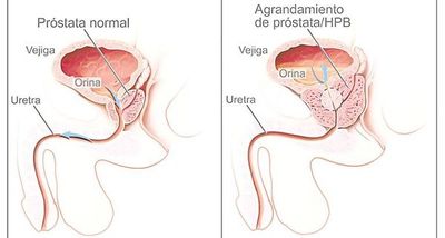 Cáncer de próstata con la opción de cirugía robótica - Nacionales - ABC Color