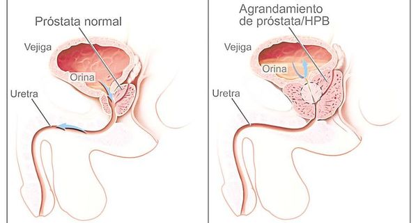 Cáncer de próstata con la opción de cirugía robótica  - Nacionales - ABC Color