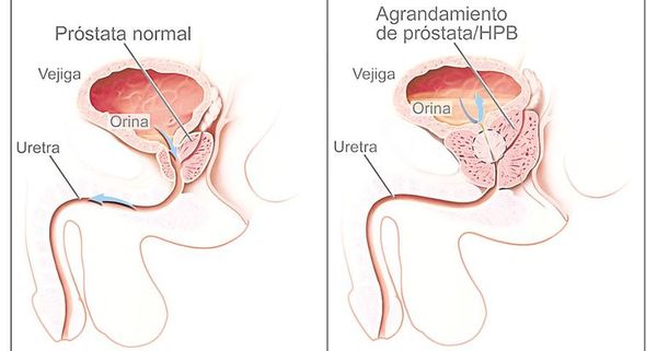 Cáncer de próstata con la opción de cirugía robótica - Nacionales - ABC Color