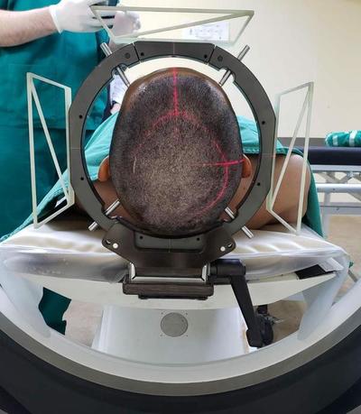 Neurocirugía estereotáxica: Hospital de Clínicas implementa innovadora técnica » Ñanduti