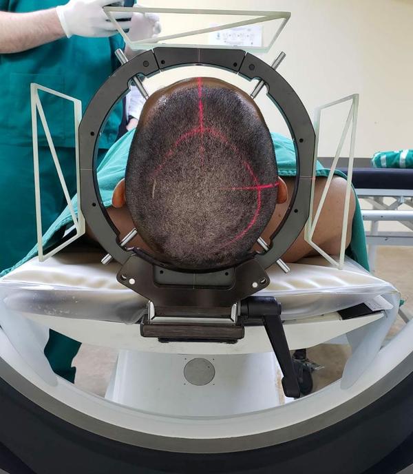 Neurocirugía estereotáxica: Hospital de Clínicas implementa innovadora técnica » Ñanduti