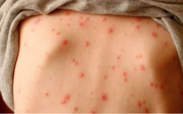 Paraguay en alerta por casos de sarampión y difteria en la región - Megacadena — Últimas Noticias de Paraguay