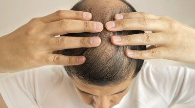 Caída del cabello puede ser una señal de una enfermedad hormonal o estrés