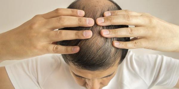 La caída del cabello puede ser de origen multifactorial y con tratamientos variados » San Lorenzo PY