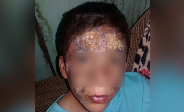 Niño sufre quemaduras al intentar rescatar su bicicleta de un incendio