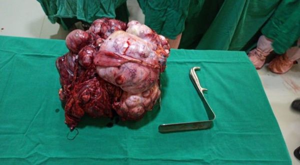 Extraen tumor de 15 kilos a una paciente en Itauguá