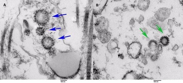 HOY / Detectan coronavirus en los testículos de hombres infectados