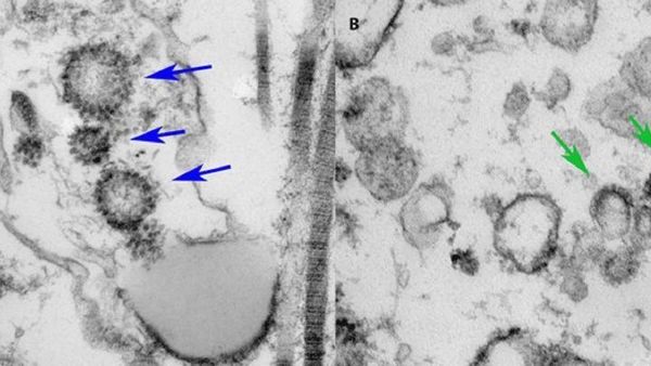 Estudio confirma la presencia de covid-19 en el tejido testicular de varios varones que estuvieron infectados