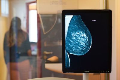 Cómo detectar a tiempo un cáncer de mama - Estilo de vida - ABC Color