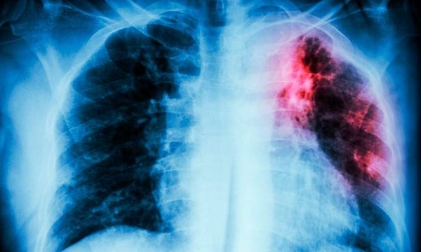 HOY / Creciente carga de tuberculosis en las cárceles arriesga control de la enfermedad en el país, advierten