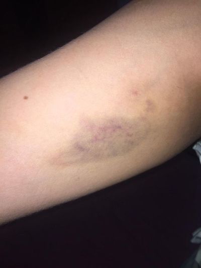 Concejal de Pedro Juan es denunciado nuevamente por una brutal golpiza a su pareja - Nacionales - ABC Color