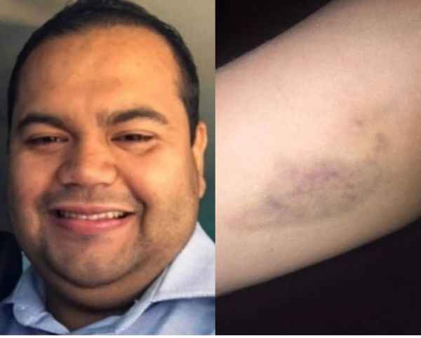 Concejal Martín Pocho fue denunciado por agredir brutalmente a su concubina en PJC