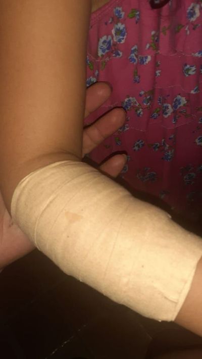Perro muerde a niña en San Antonio - Nacionales - ABC Color