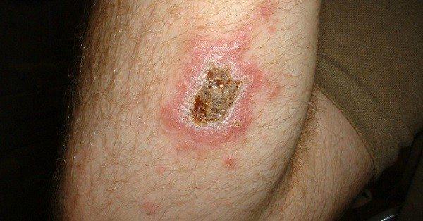 La leishmaniasis, es una enfermedad canina que afecta a las personas – Prensa 5