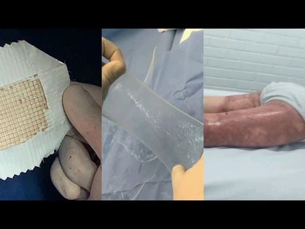 Combinan técnica MEEK con membrana amniótica y salvan la vida a niño de 3 años