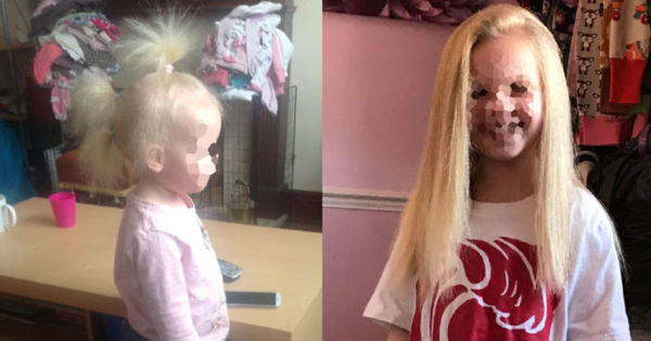 El extraño síndrome en el pelo de una niña que le ha impedido peinarse bien durante 9 años - C9N