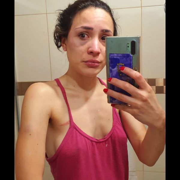 Mujer denuncia que su pareja la golpeó brutalmente: "Me dijeron que tengo suerte que no fueron a mi velorio" » Ñanduti