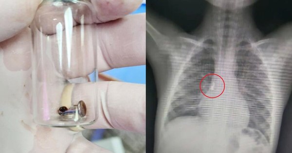 La Nación / Logran extraer parte metálica de cortaúñas que pequeño niño aspiró accidentalmente