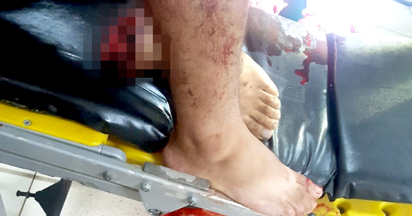 Arrolló a su amigo con su propio vehículo y le arrancó un pie - Noticiero Paraguay