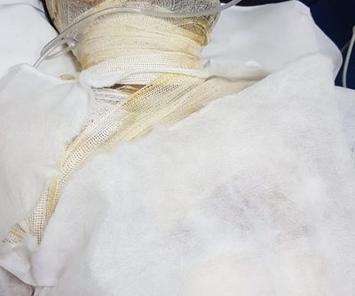 Hombre se prendió fuego tras discutir con su pareja