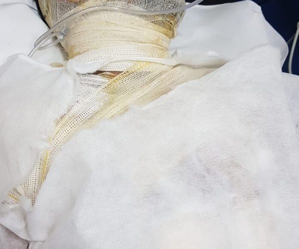 Hombre se prendió fuego tras discutir con su pareja