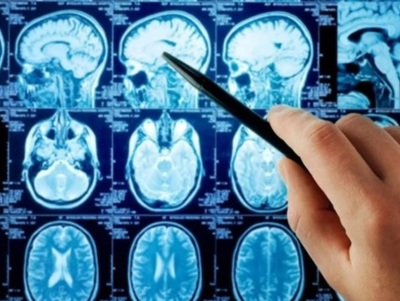 ¿Qué es la «niebla mental» que afecta a las personas recuperadas de coronavirus? | OnLivePy