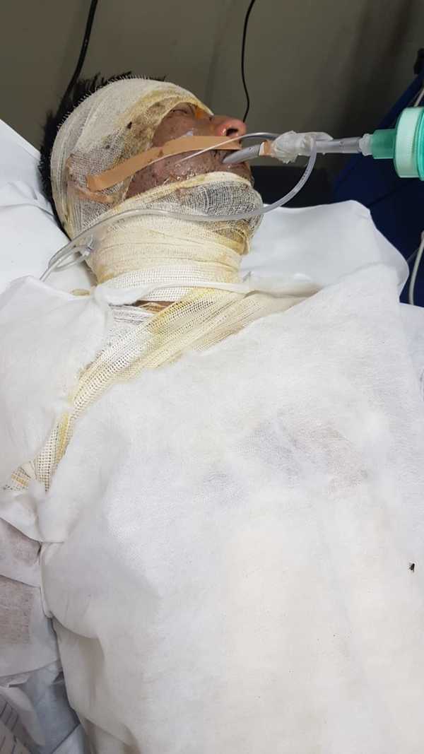 Hombre que se “bañó” con alcohol y se prendió fuego tras discutir con su pareja murió ayer