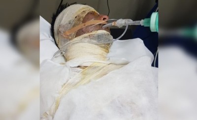 Muere hombre que se prendió fuego tras discutir con su pareja