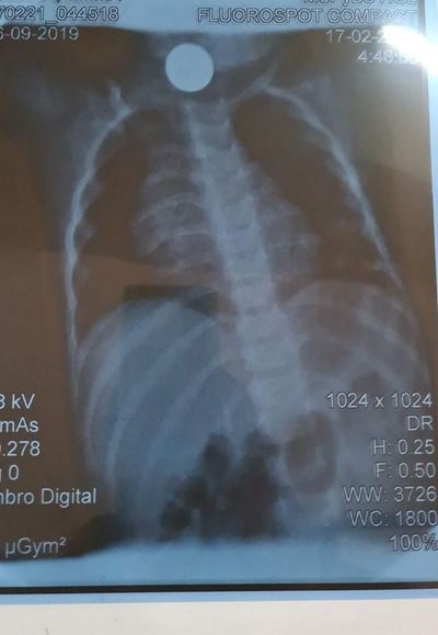 Extraen moneda de garganta de una niña - Nacionales - ABC Color
