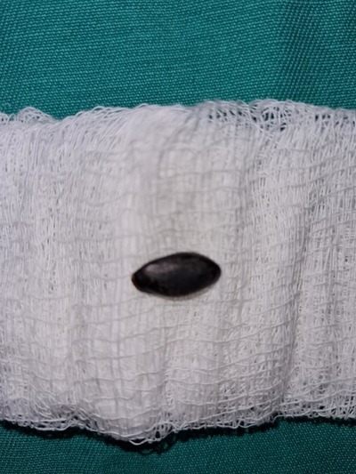 “Por obra de Dios no murió asfixiada”, dice doctor sobre la niña que aspiró una semilla de girasol en Concepción | Ñanduti