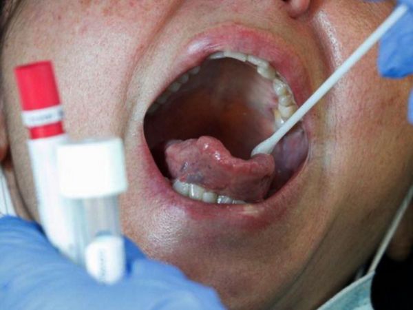 Lesiones en la lengua, señal temprana en el diagnóstico de Covid